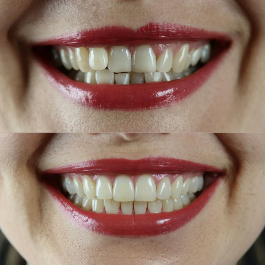 Perfect Teeth - AI Photo Editing Tool